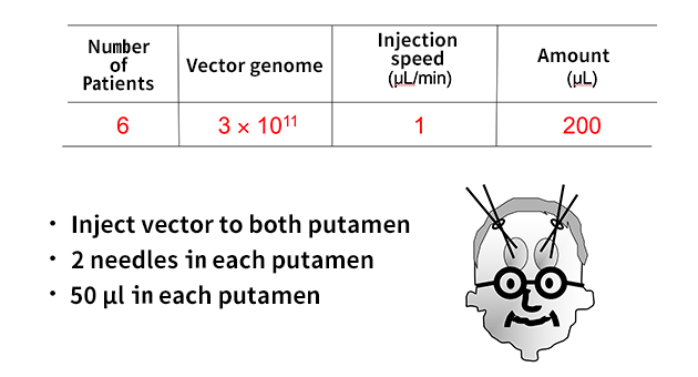 Only 50 microliters AAV vector injection in each of 4 needles.